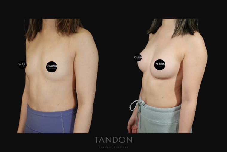 Breast Augmentation Before & After Gallery - Patient 167079 - Image 5