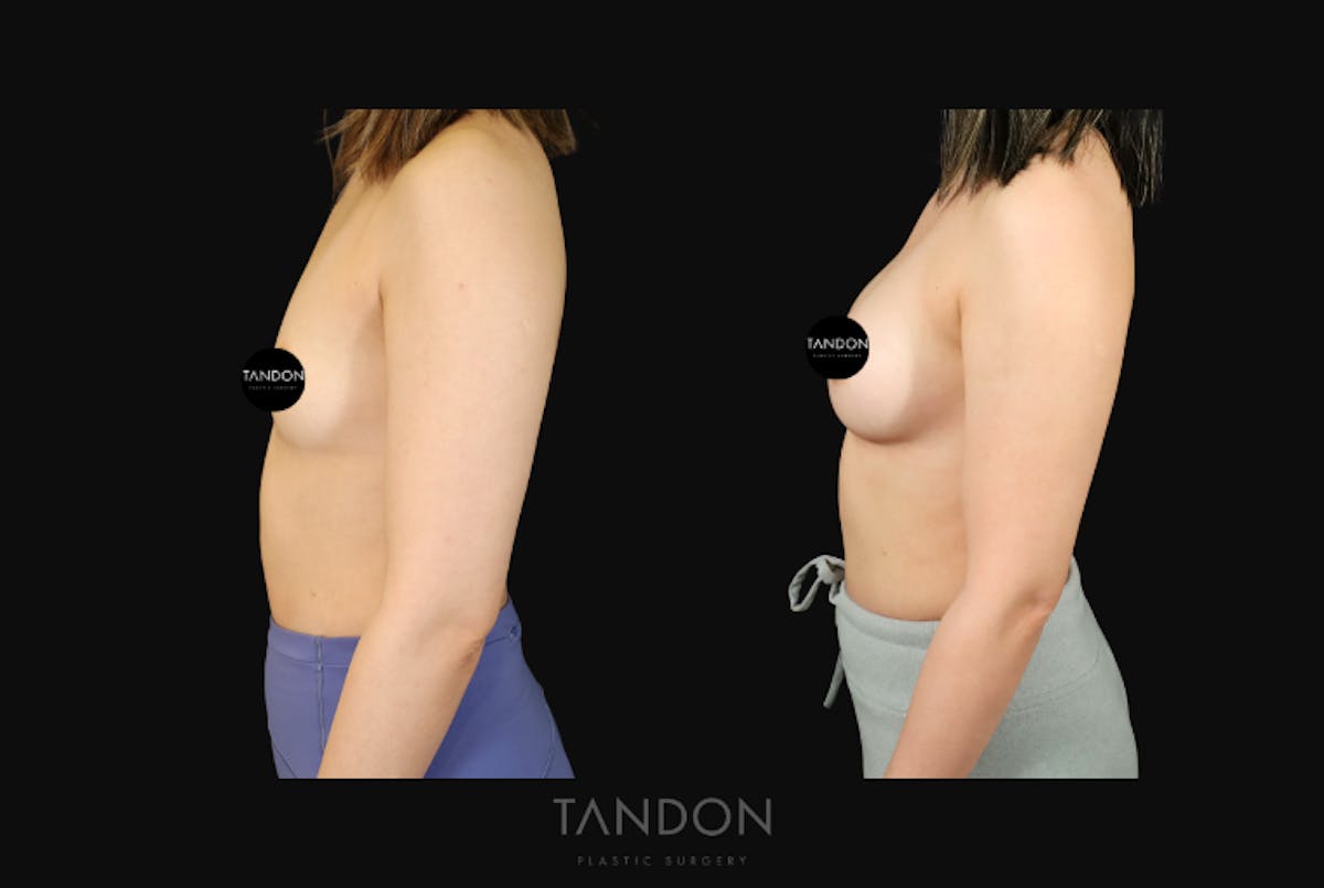 Breast Augmentation Before & After Gallery - Patient 167079 - Image 4