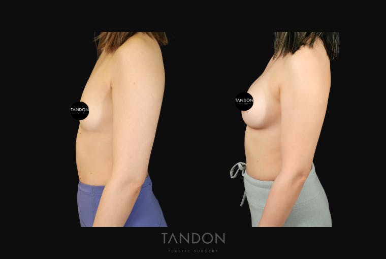 Breast Augmentation Before & After Gallery - Patient 167079 - Image 4