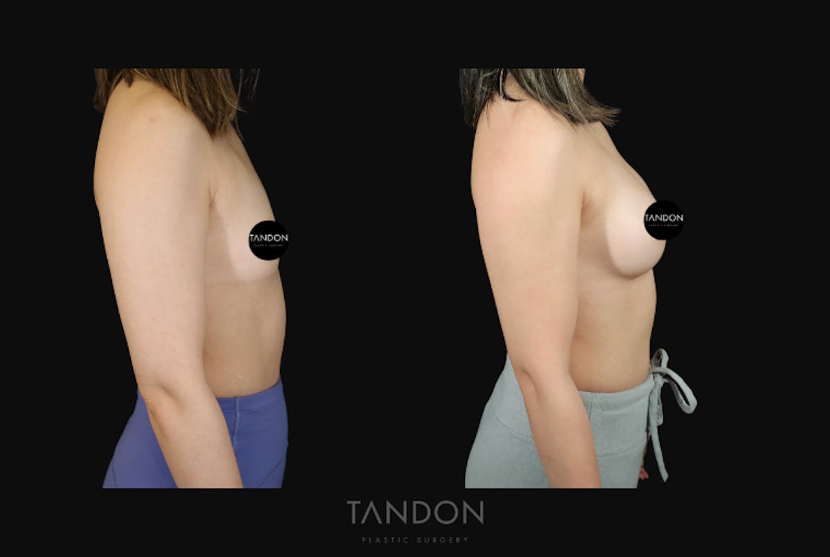 Breast Augmentation Before & After Gallery - Patient 167079 - Image 3