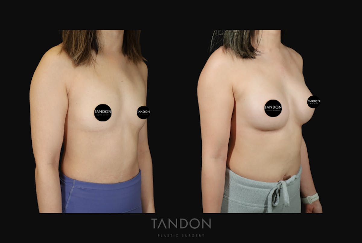 Breast Augmentation Before & After Gallery - Patient 167079 - Image 2