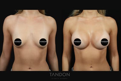 Preservé by Motiva Breast Augmentation Before & After Gallery - Patient 140568 - Image 1