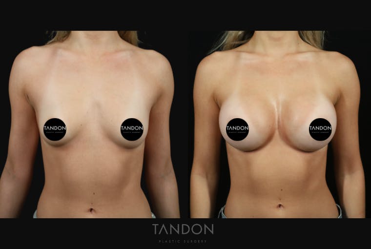 Preservé by Motiva Breast Augmentation Before & After Gallery - Patient 140568 - Image 1