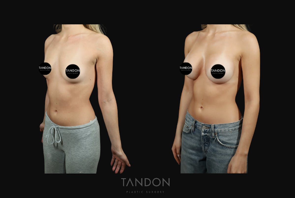Preservé by Motiva Breast Augmentation Before & After Gallery - Patient 140568 - Image 2