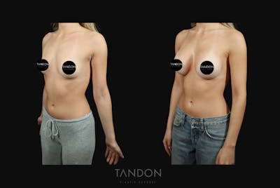 Preservé by Motiva Breast Augmentation Before & After Gallery - Patient 140568 - Image 2