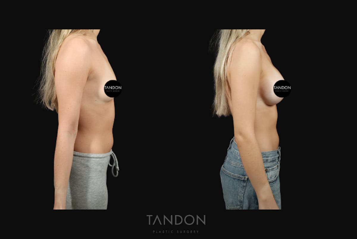 Preservé by Motiva Breast Augmentation Before & After Gallery - Patient 140568 - Image 3
