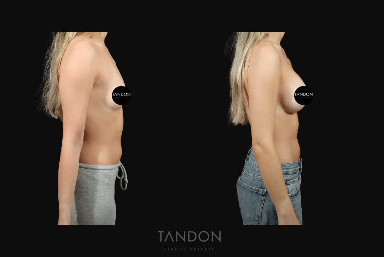 Preservé by Motiva Breast Augmentation Before & After Gallery - Patient 140568 - Image 3
