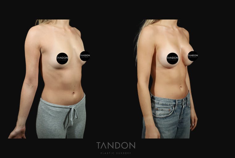 Preservé by Motiva Breast Augmentation Before & After Gallery - Patient 140568 - Image 4