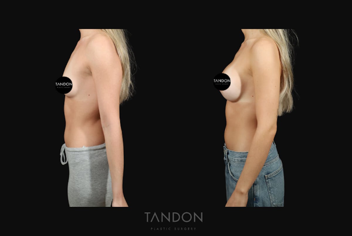 Preservé by Motiva Breast Augmentation Before & After Gallery - Patient 140568 - Image 5