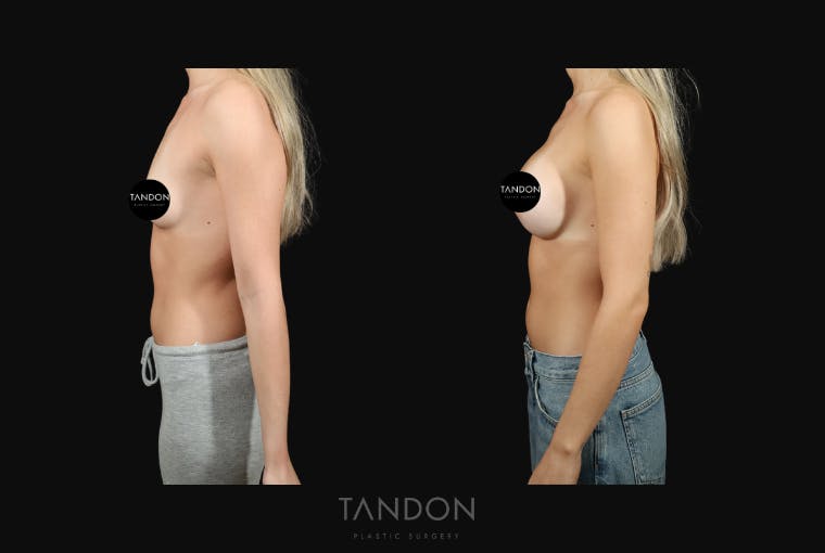 Preservé by Motiva Breast Augmentation Before & After Gallery - Patient 140568 - Image 5