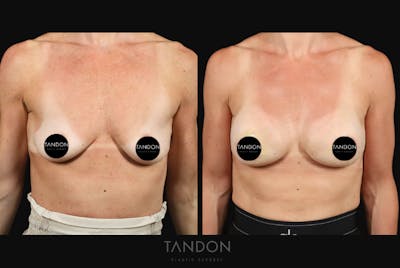 Preservé by Motiva Breast Augmentation Before & After Gallery - Patient 363939 - Image 1