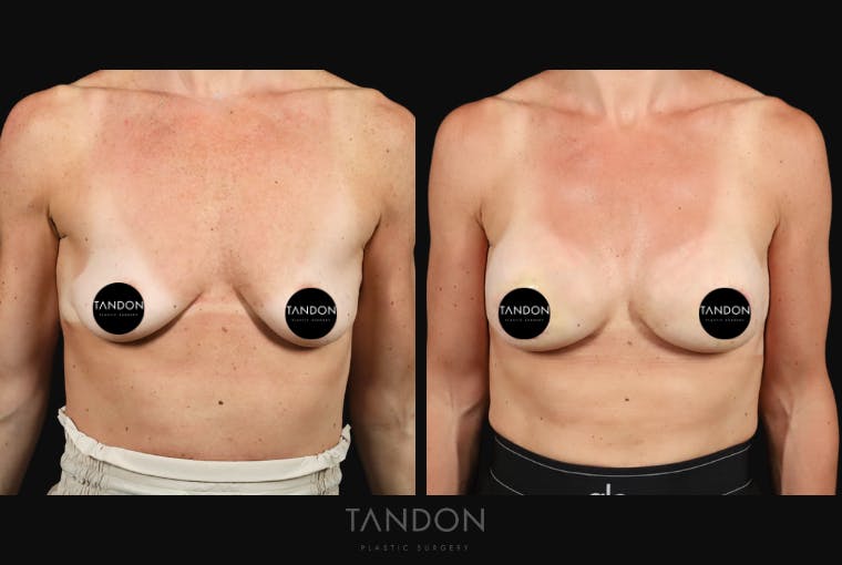 Preservé by Motiva Breast Augmentation Before & After Gallery - Patient 363939 - Image 1