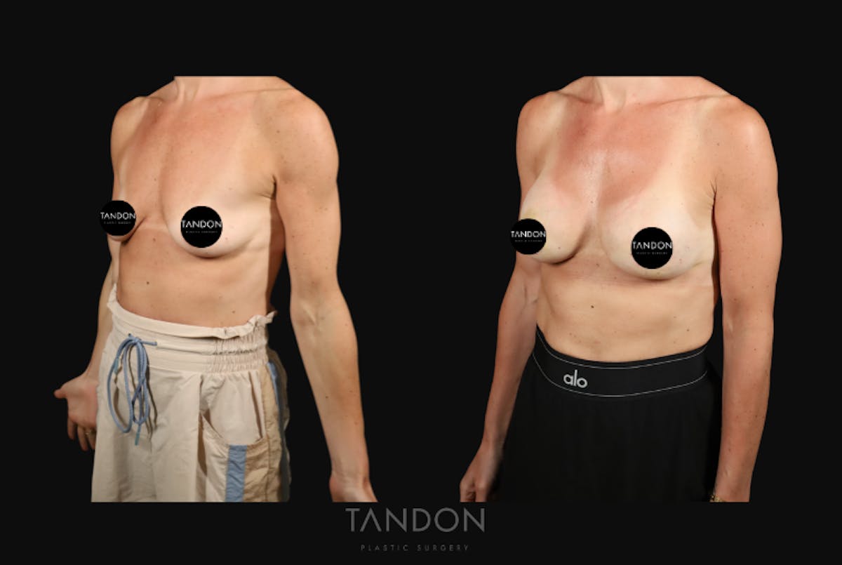 Preservé by Motiva Breast Augmentation Before & After Gallery - Patient 363939 - Image 2