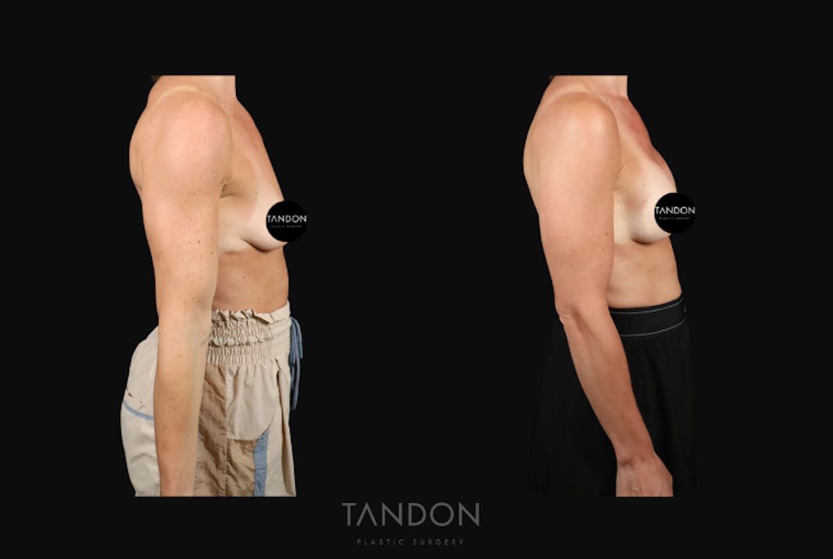 Preservé by Motiva Breast Augmentation Before & After Gallery - Patient 363939 - Image 3