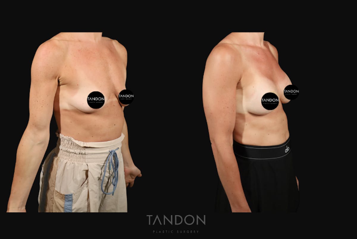 Breast Augmentation Before & After Gallery - Patient 160872 - Image 4
