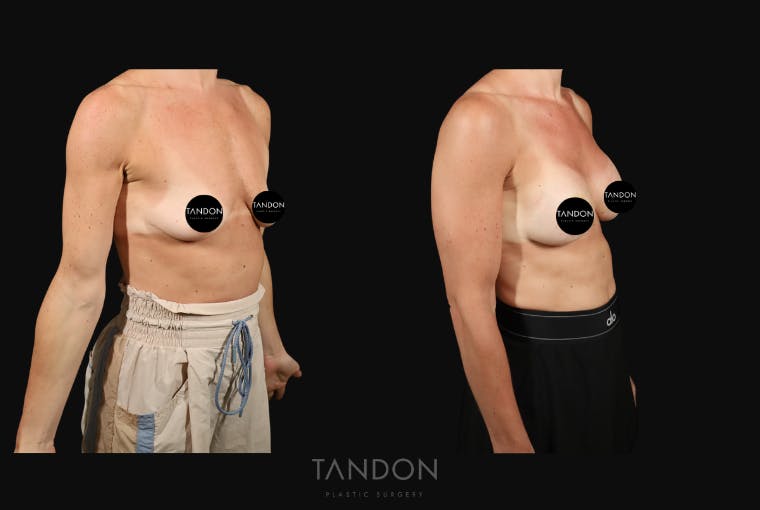 Breast Augmentation Before & After Gallery - Patient 160872 - Image 4