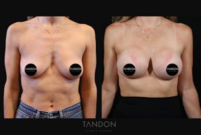 Preservé by Motiva Breast Augmentation Before & After Gallery - Patient 193669 - Image 1