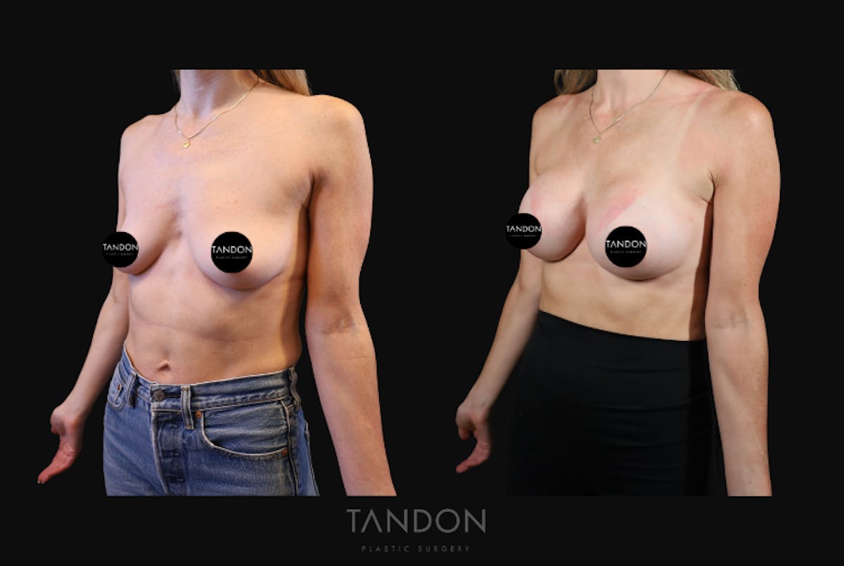 Preservé by Motiva Breast Augmentation Before & After Gallery - Patient 193669 - Image 2