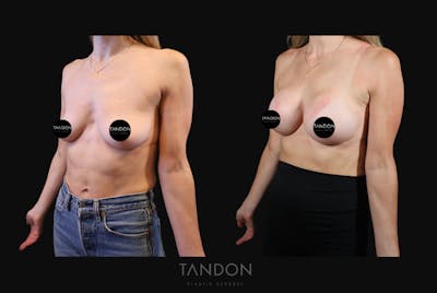 Preservé by Motiva Breast Augmentation Before & After Gallery - Patient 193669 - Image 2