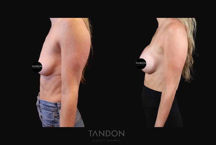 Preservé by Motiva Breast Augmentation Before & After Gallery - Patient 193669 - Image 3