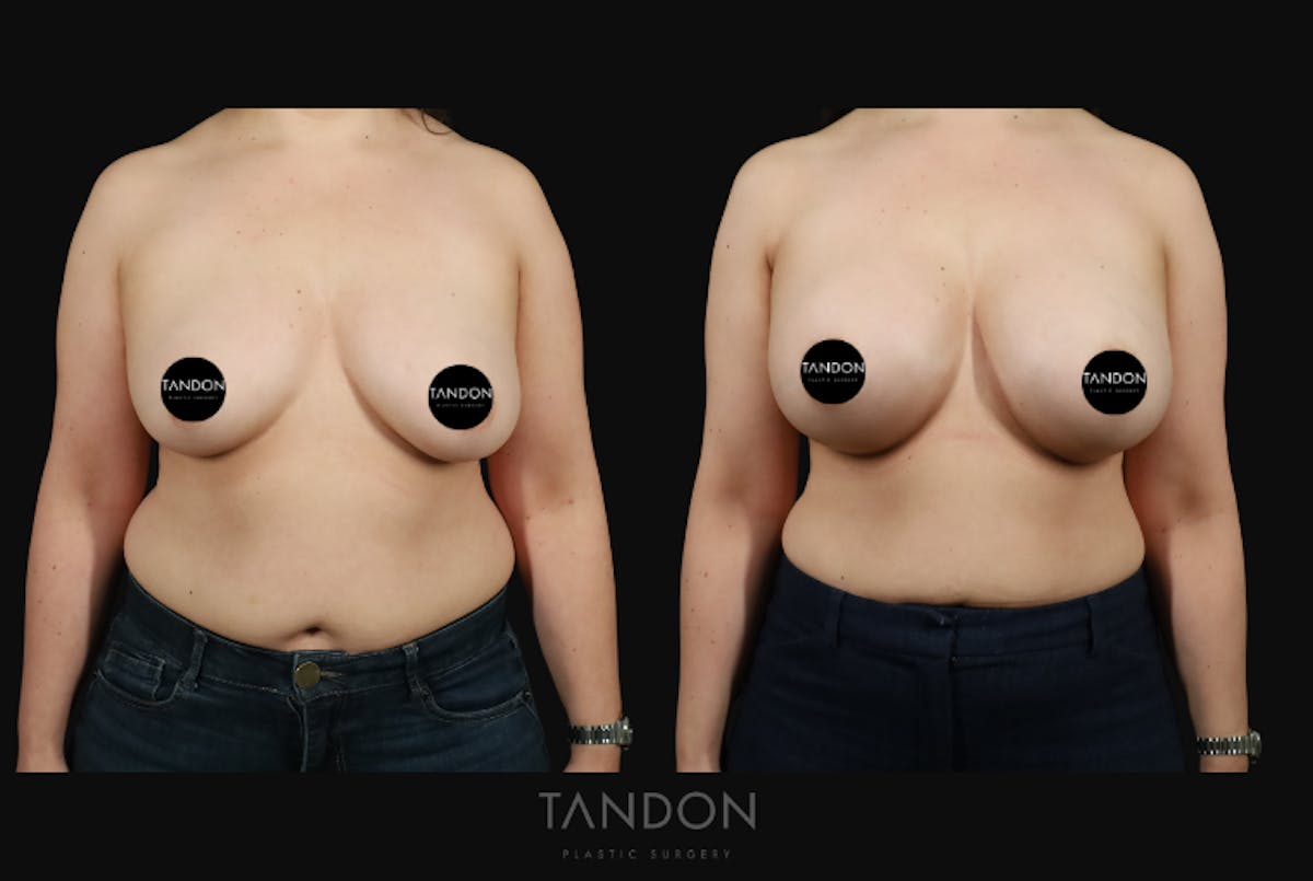Breast Augmentation  Before & After Gallery - Patient 529178 - Image 1