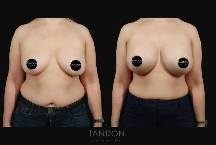 Breast Augmentation Before & After Gallery - Patient 529178 - Image 1