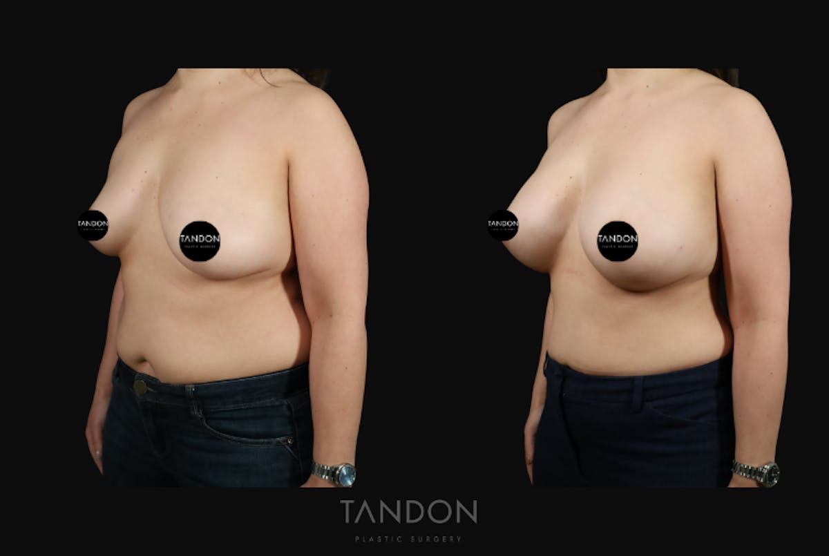 Breast Augmentation  Before & After Gallery - Patient 529178 - Image 2