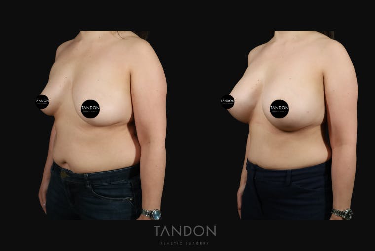 Breast Augmentation Before & After Gallery - Patient 529178 - Image 2