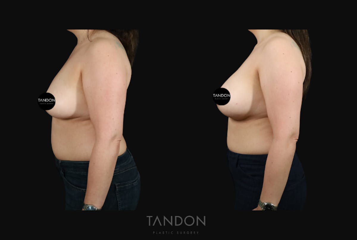 Breast Augmentation  Before & After Gallery - Patient 529178 - Image 3