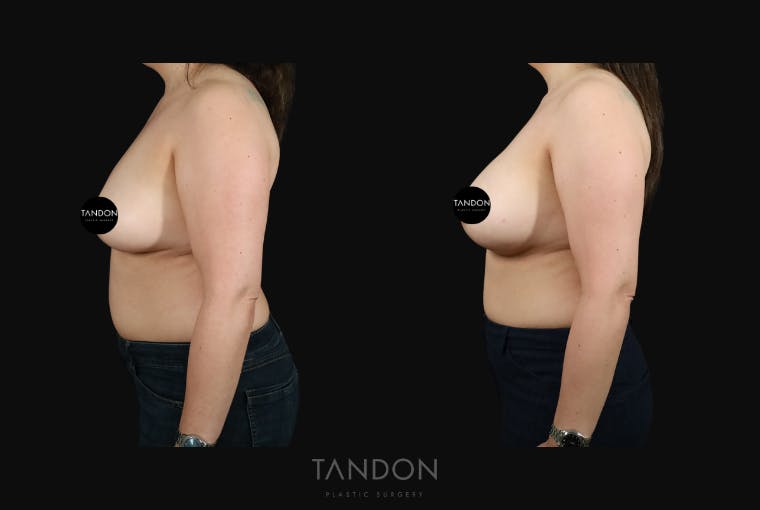 Breast Augmentation Before & After Gallery - Patient 529178 - Image 3