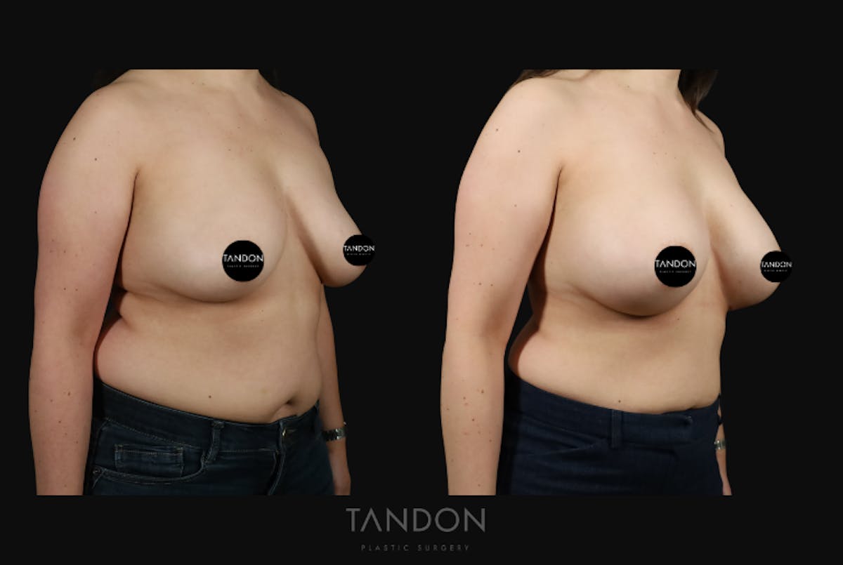 Breast Augmentation  Before & After Gallery - Patient 529178 - Image 4
