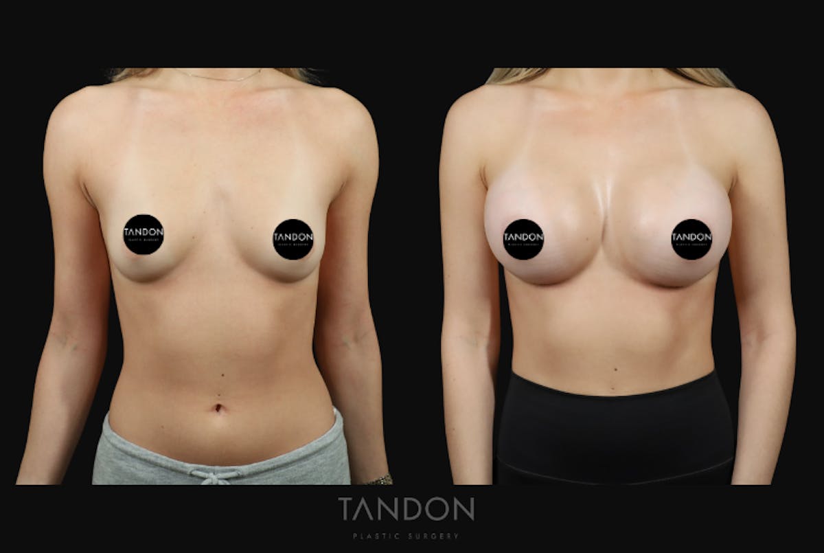 Preservé by Motiva Breast Augmentation Before & After Gallery - Patient 369012 - Image 1