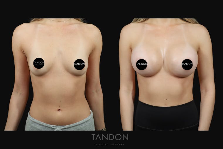 Preservé by Motiva Breast Augmentation Before & After Gallery - Patient 369012 - Image 1