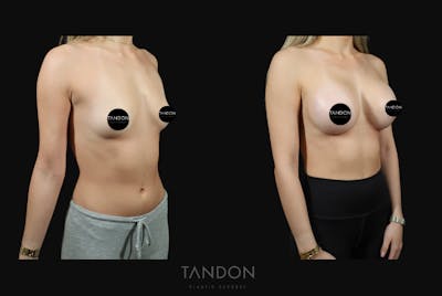 Preservé by Motiva Breast Augmentation Before & After Gallery - Patient 369012 - Image 2