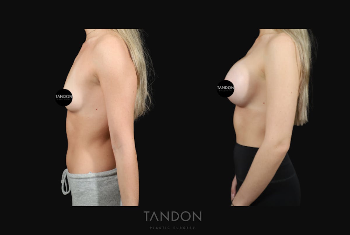 Preservé by Motiva Breast Augmentation Before & After Gallery - Patient 369012 - Image 3