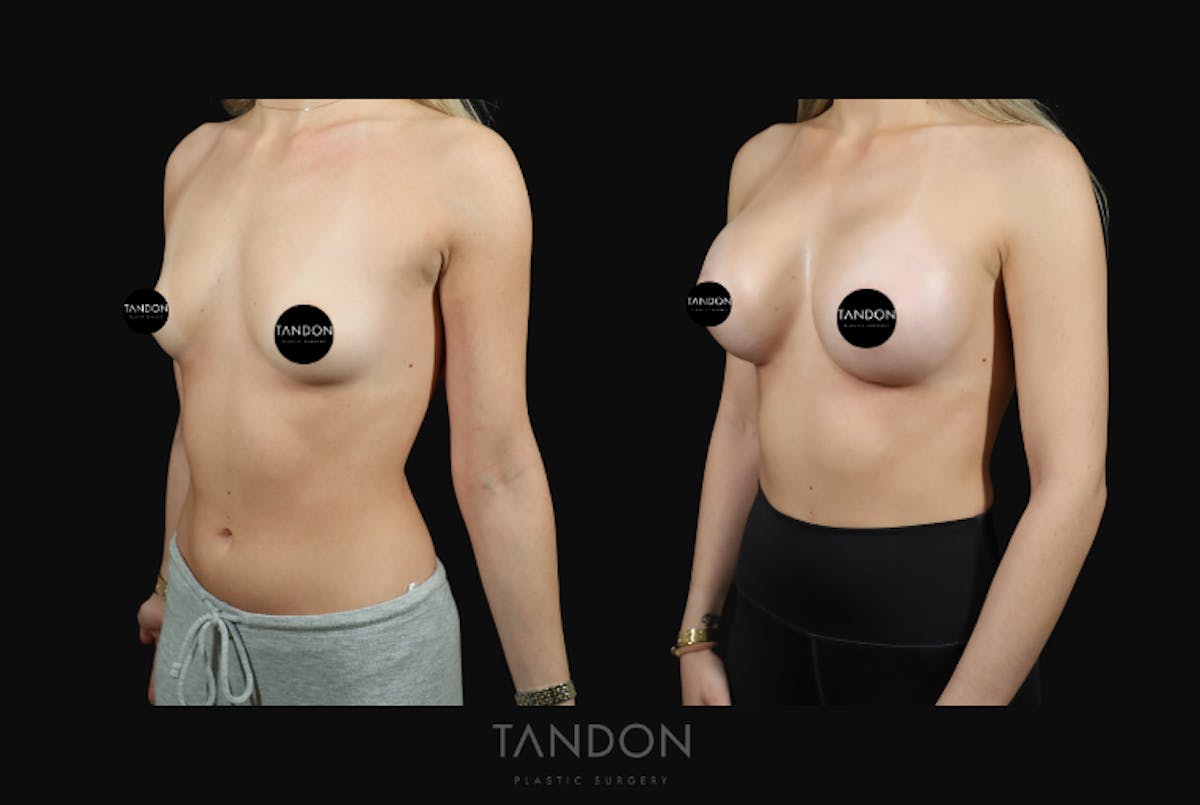 Preservé by Motiva Breast Augmentation Before & After Gallery - Patient 369012 - Image 4