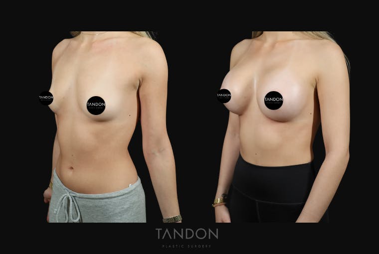 Preservé by Motiva Breast Augmentation Before & After Gallery - Patient 369012 - Image 4
