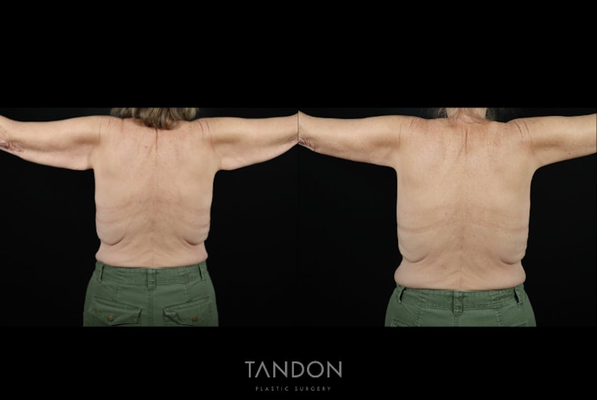 Arm Lift (Brachioplasty) Before & After Gallery - Patient 194357 - Image 3