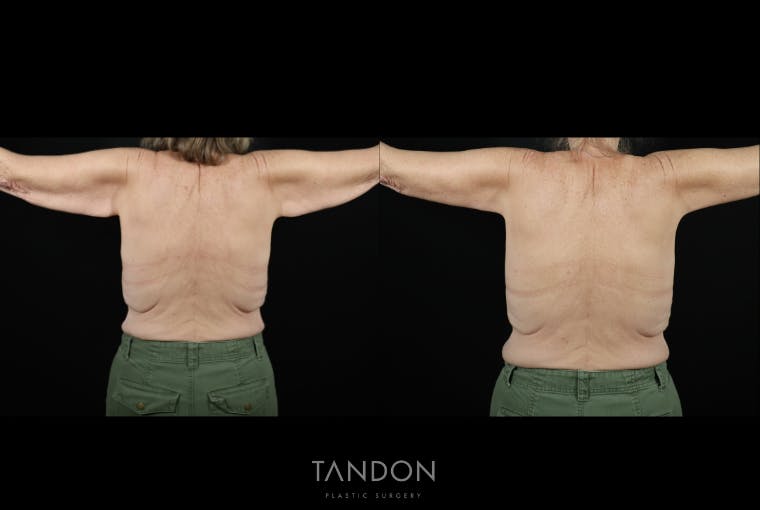 Arm Lift (Brachioplasty) Before & After Gallery - Patient 194357 - Image 3