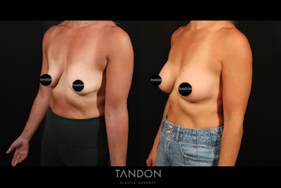 Preservé by Motiva Breast Augmentation Before & After Gallery - Patient 300542 - Image 2