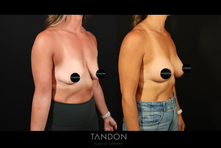 Preservé by Motiva Breast Augmentation Before & After Gallery - Patient 300542 - Image 5