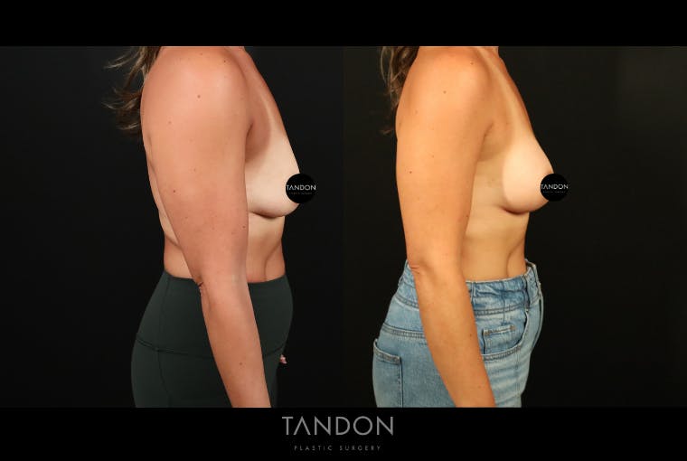 Preservé by Motiva Breast Augmentation Before & After Gallery - Patient 300542 - Image 4