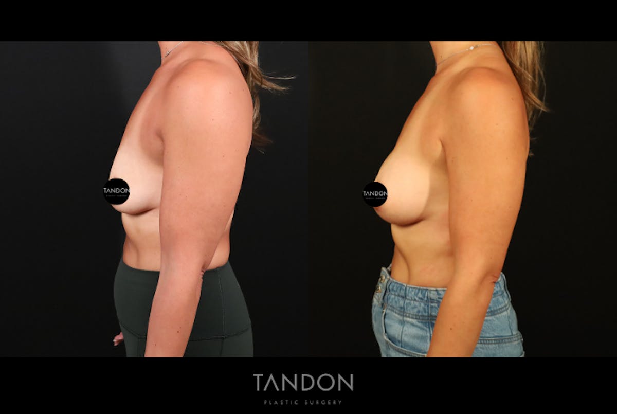 Preservé by Motiva Breast Augmentation Before & After Gallery - Patient 300542 - Image 3