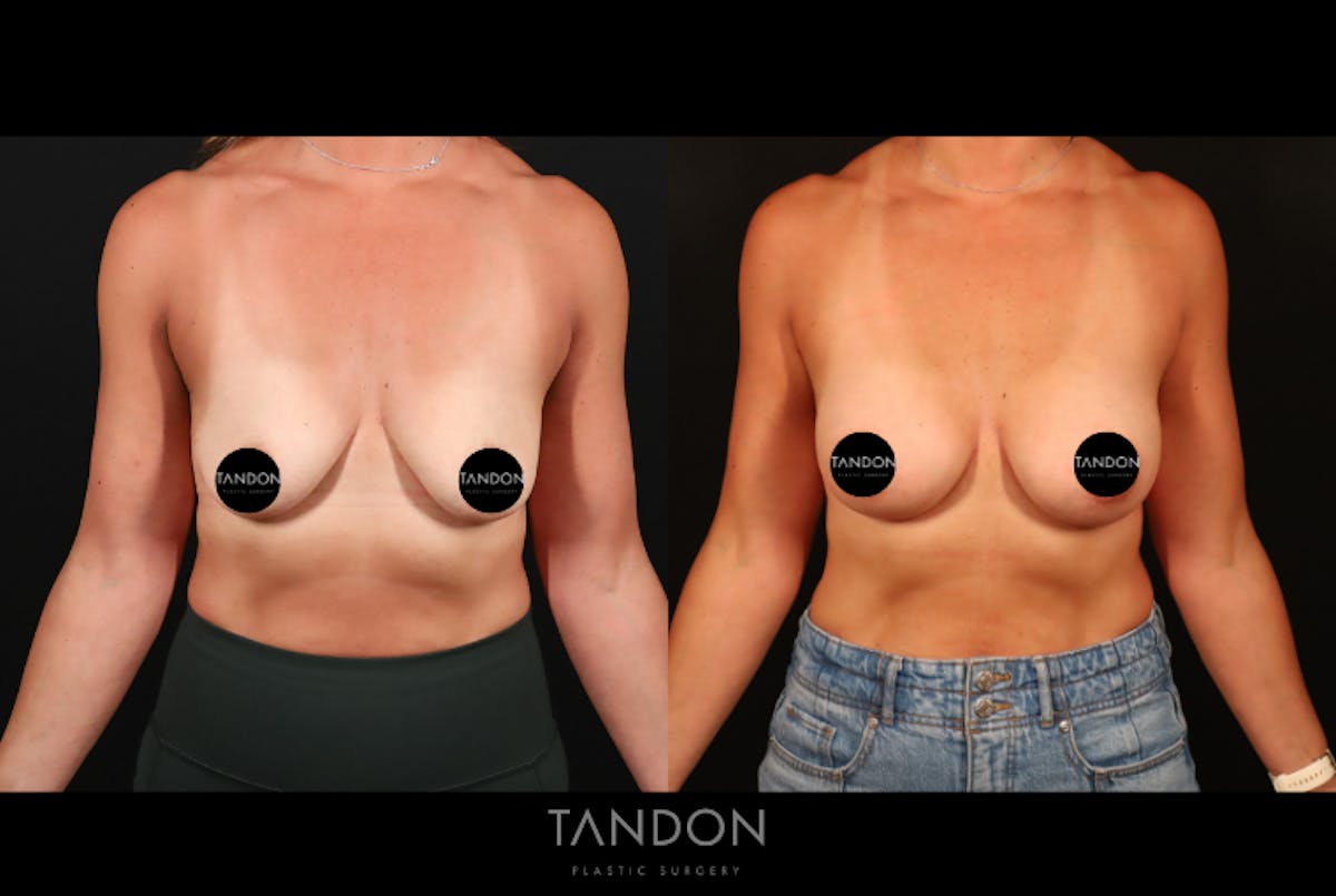 Preservé by Motiva Breast Augmentation Before & After Gallery - Patient 300542 - Image 1
