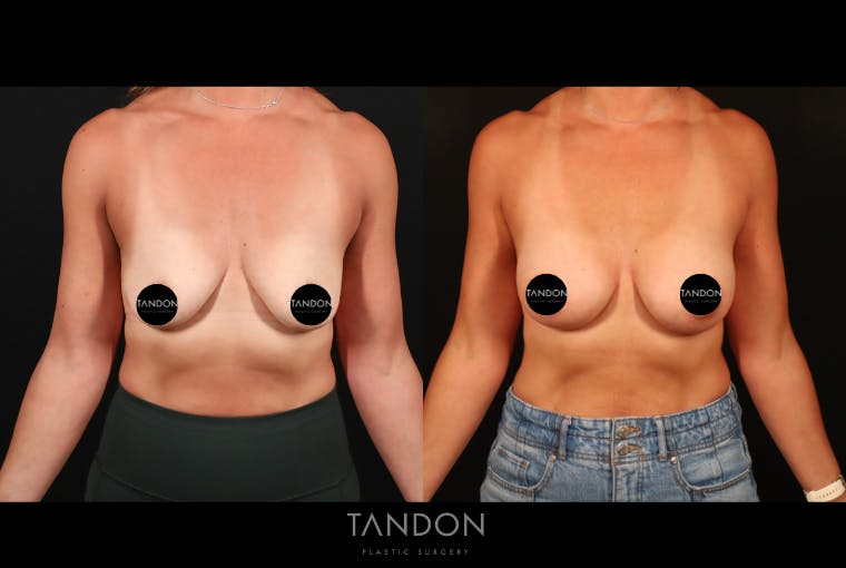 Preservé by Motiva Breast Augmentation Before & After Gallery - Patient 300542 - Image 1