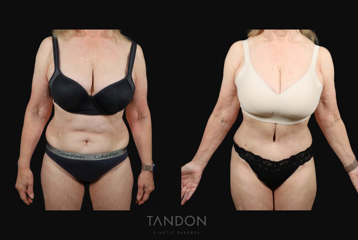 Abdominoplasty (Tummy Tuck) Before & After Gallery - Patient 217134 - Image 1