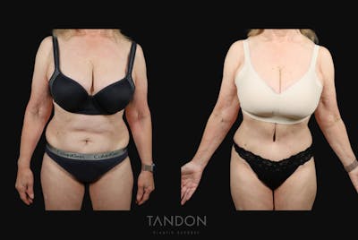 Abdominoplasty (Tummy Tuck) Before & After Gallery - Patient 217134 - Image 1