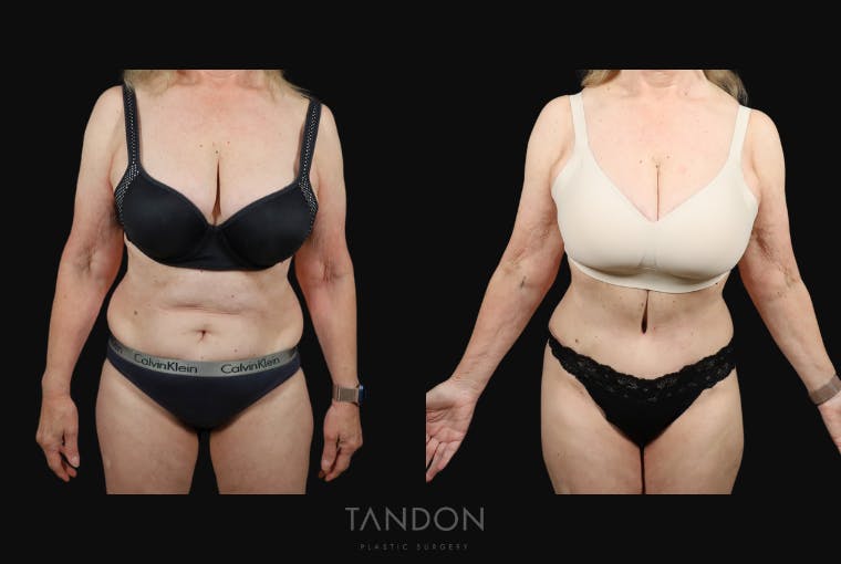 Abdominoplasty (Tummy Tuck) Before & After Gallery - Patient 217134 - Image 1