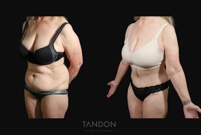 Abdominoplasty (Tummy Tuck) Before & After Gallery - Patient 217134 - Image 2