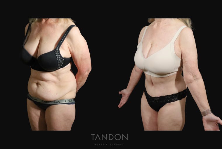 Abdominoplasty (Tummy Tuck) Before & After Gallery - Patient 217134 - Image 2